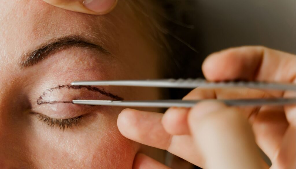 blefaroplastie cluj