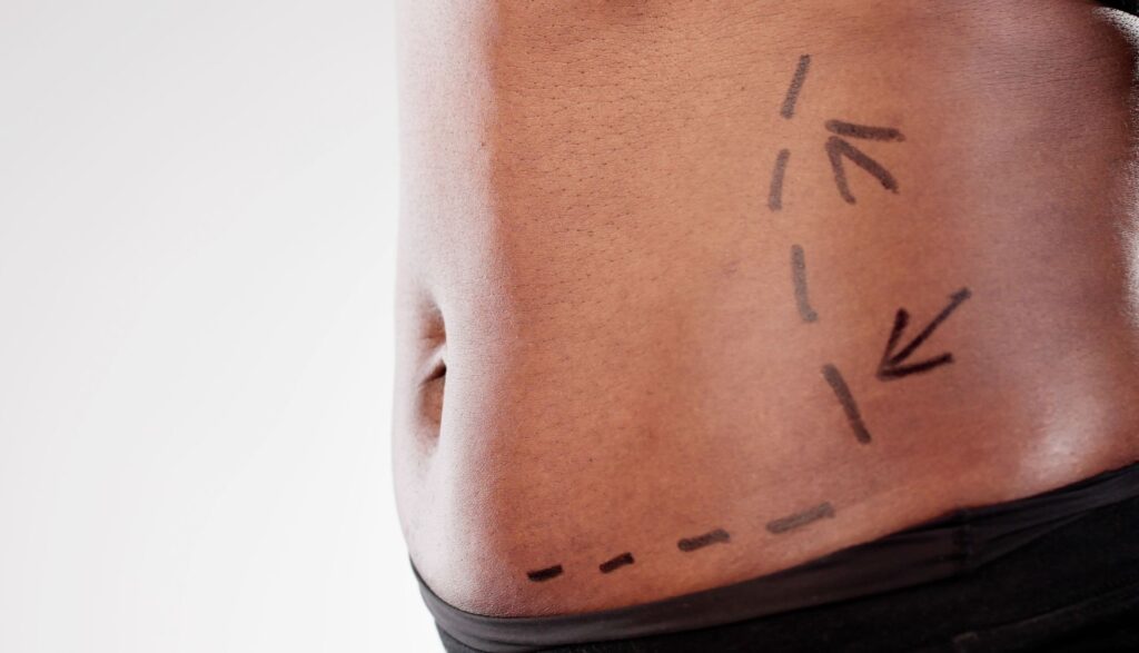 abdomen umflat dupa abdominoplastie