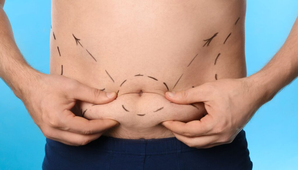 abdominoplastie barbati