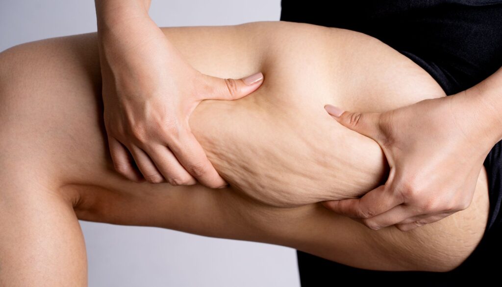 liposuctie picioare