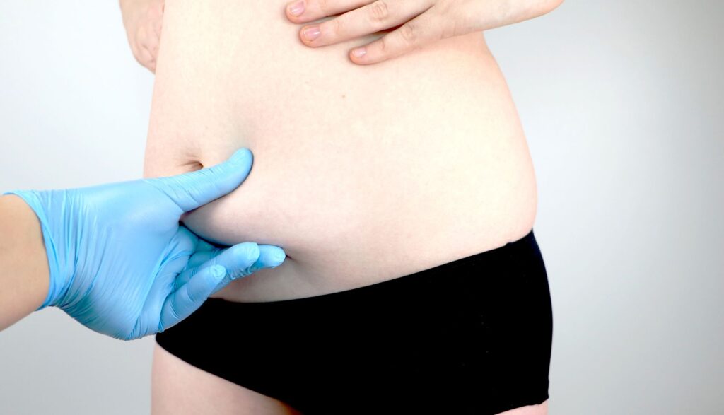 recuperare dupa abdominoplastie