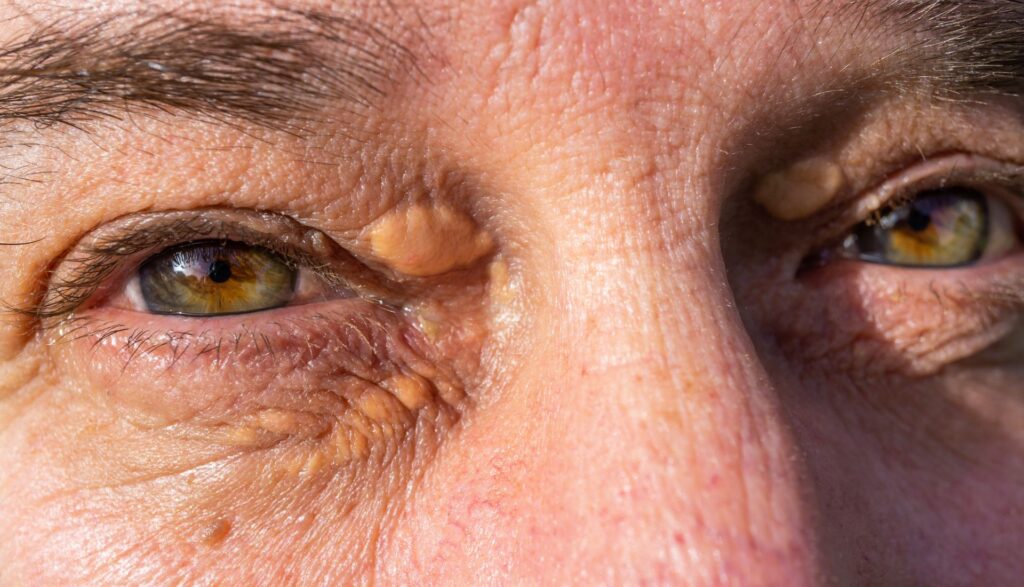 xantelasma