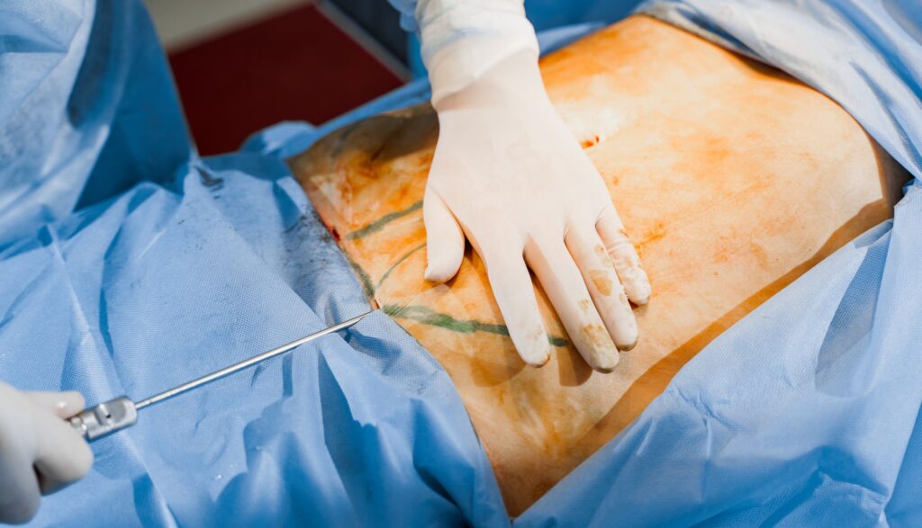 abdominoplastie cluj