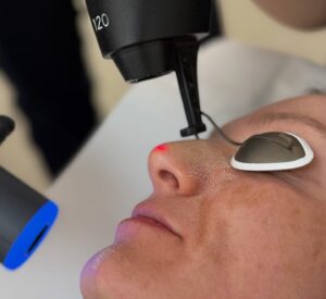 Recuperare Laser CO2