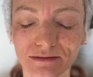 laser co2 fractionat