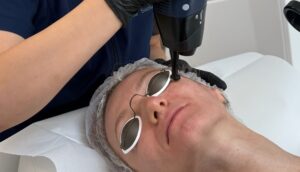 Efecte Secundare și Contraindicații Laser CO2: Ce trebuie să știi înainte de procedură