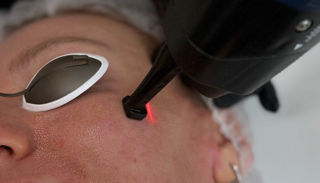 Ce să nu faci înainte de Laser CO2: reguli esențiale pentru un tratament sigur