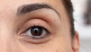 tratament cearcane cu acid hialuronic