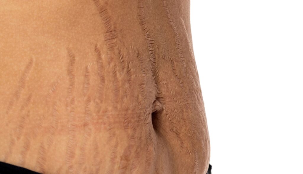 Tratamentul cu laser pentru vergeturi