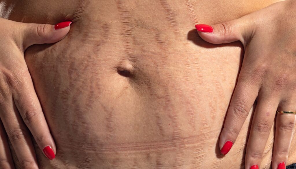 cum scap de vergeturi