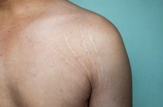 vergeturile la barbati