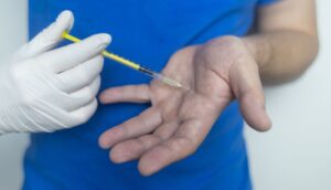 hiperhidroza palmara transpiratia excesiva a mainilor