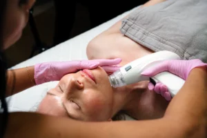 microneedling cu radiofrecventa