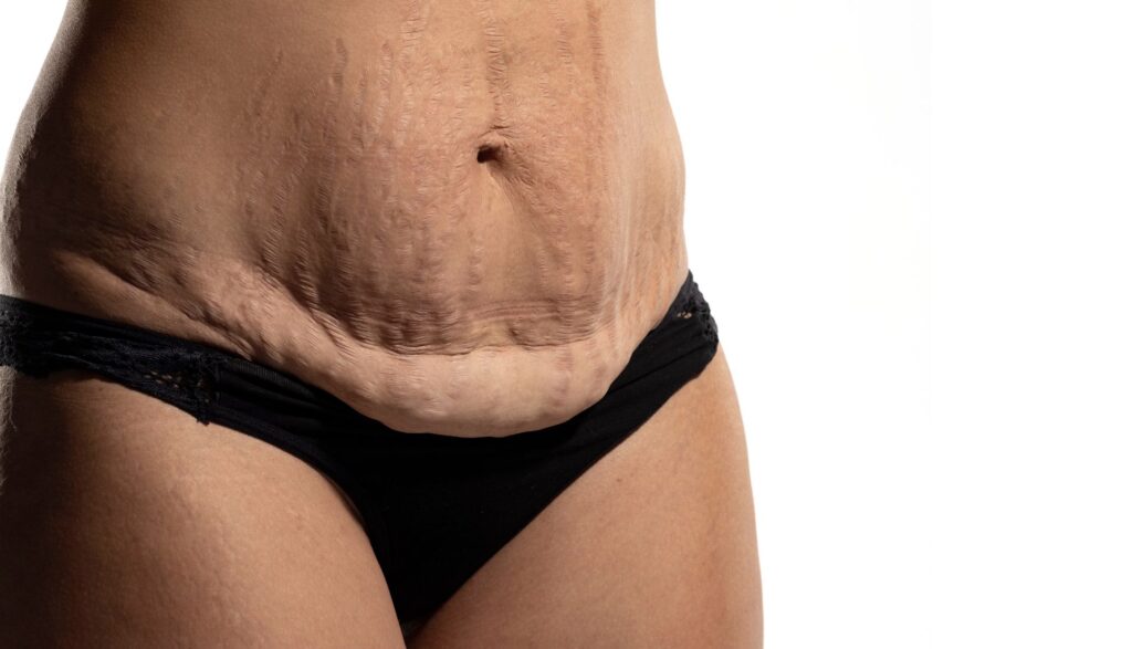 pielea lasata dupa slabire