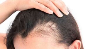 Alopecia androgenetică