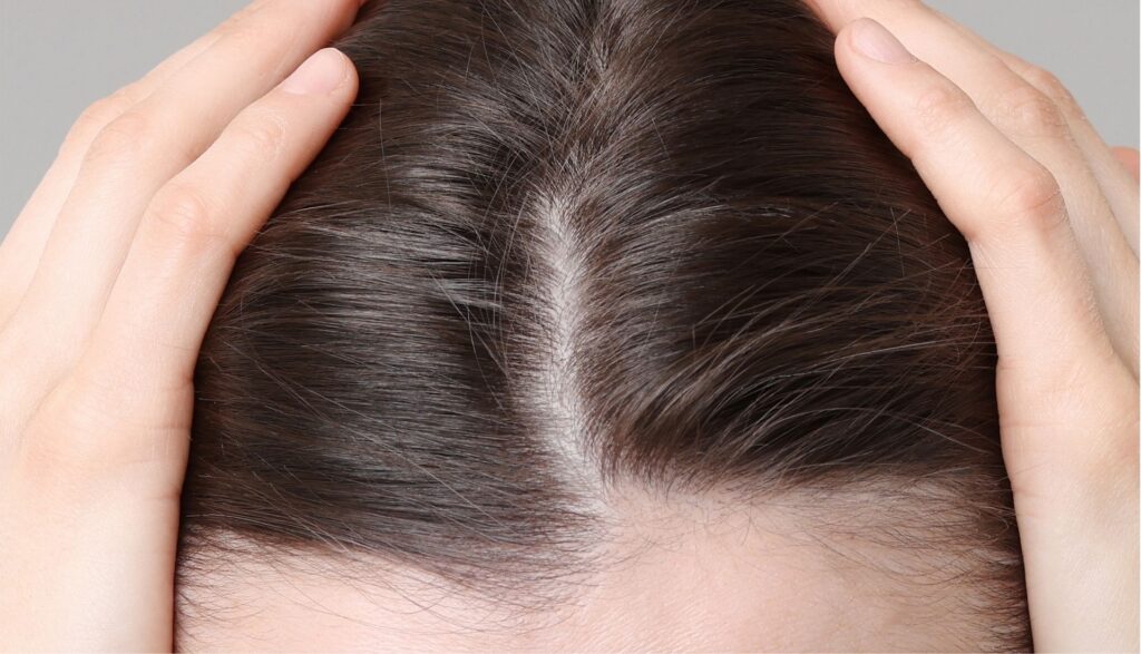 alopecia