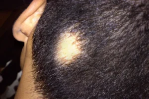 alopecia areata