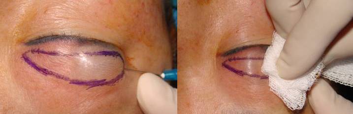 anestezia in blefaroplastie